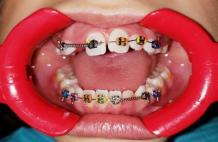 Types of Adult Braces Available - good-orthodontist-nearby.over-blog.com