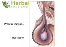 Hydrocele Symptoms, Causes, Diagnosed And Treatment - Herbal Care Products