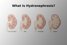  What is hydronephrosis?