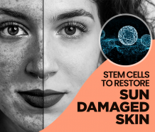 Stem Cells to Restore Sun Damaged Skin | R3 Stem Cell