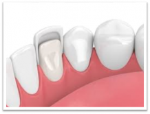 Dental Veneers and their Benefits