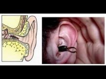 What Happens If A Centipede Enters Your Ear?