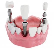 Dentist for Implants - Cost of dental Implants in Mumbai - Smile Store