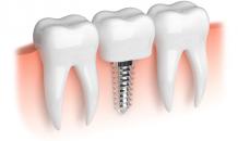 4 Advantages and Disadvantages of Dental Implants You Must Know - Uptown Dental Associates Dentist in Albuquerque, NM