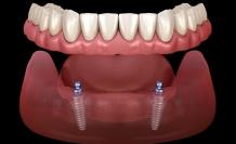 Mini-Implant Dentures: Process and Benefits | European Denture Center