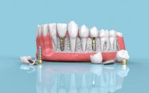 Dental Implants in Fairfield, CT