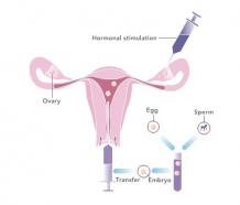 Why you should only prefer frozen egg donation banks for the eggs?