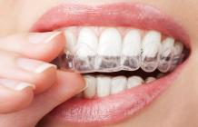 Invisalign Braces Adelaide