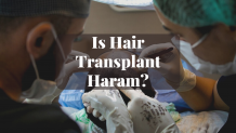 Is Hair Transplant Haram? - HalalHaramWorld