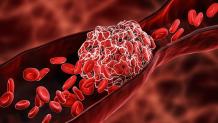 Limb Preservation in Denver - Thornton - Westminster - AHVC