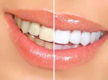 The Key Benefits Of Teeth Whitening That One Should Essentially Know About