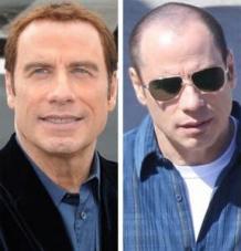 John Travolta Hair Transplant | Hair Transplant Dubai