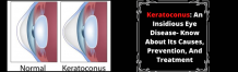 Keratoconus: An Insidious Eye Disease- Know About Its Causes, Prevention, And Treatment