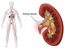 How to prevent Kidney stones with Ayurveda - Blog - Herbal &amp; Home Remedies