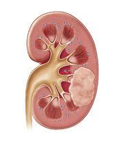 Symptoms of Kidney Cancer - Go2Article