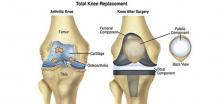 knee replacement in Delhi