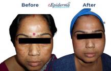 #1 Best Laser Melasma Removal Treatment in Durgapur