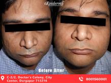 #No1 Skin Resurfacing Treatment in Durgapur