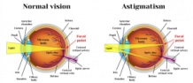 LASIK Surgery For Astigmatism Treatment