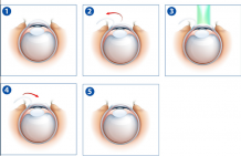 Lasik Eye Surgery cost In Bangalore | Lasik Eye Surgery cost In India