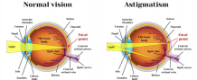 LASIK Surgery For Astigmatism Treatment