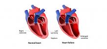 What Is the Most Common Cause of Right Sided Heart Failure? | Dr. Raghu