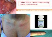 Lichen Planus Herbal Treatment and Symptoms, Causes - Herbal Care Products