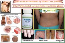 10 Natural Remedies for Lichen Planus - Herbal Care Products