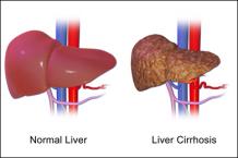 Natural Treatment of Liver Cirrhosis, Herbal Remedies - Causes &amp; Symptoms