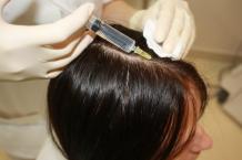  Mesotherapy: Procedure, Side Effects, and Benefits - Best Hair Transplantation Dubai 