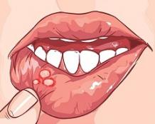 Causes, Symptoms &amp; Remedies of Mouth Ulcers - Causes, Symptoms &amp; Remedies of Mouth Ulcers - Quora