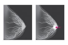 Mammogram for Breast Cancer: Screening. Mammography