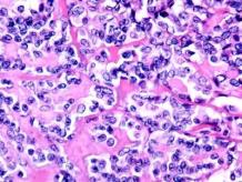  Medullary Carcinoma of Breast Treatment in India | Healing Touristry
