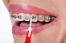 Metal braces for teeth | Metal braces cost in Mumbai | Smile Store