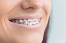  Metal Braces Treatment in India | Healing Touristry