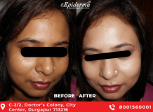 #1 Best Medi Facial Treatments in Durgapur