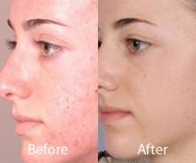 Microdermabrasion Clinic in Delhi | Microdermabrasion Treatment For Acne