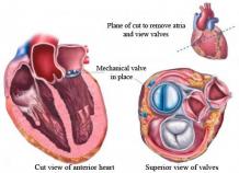  Mitral Valve Replacement Surgery in India - Healing Touristry