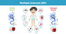 Multiple Sclerosis - Causes, Signs and Ayurvedic Treatment