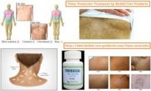 Natural Remedies for Tinea Versicolor | Natural Treatment for Tinea Versicolor - Herbal Care Products