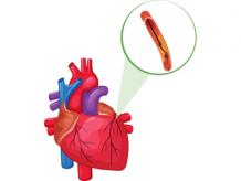 What Are the Risks of Coronary Angiography?