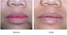 Non Surgical Lip Correction in Tirupati | Lip Reduction Clinic in Tirupati