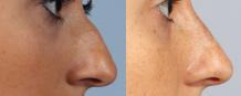 Non surgical Nose Correction in Tirupati | Nose Reshaping in Tirupati