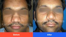 Nose Surgery In Pune | Rhinoplasty Cost In Pune