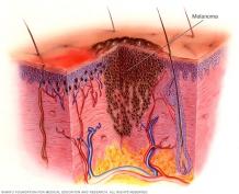 Oncolytic Probiotics Mediated Melanoma Treatment - Creative Biogene