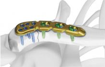 Orthopedic Implants: Screws &amp; Plates - Siiora.lk