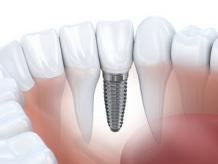 Osseointegration Implants Are New Type of Dental Implant Designed To Fuse With The Bone In The Jaw