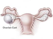 Ovarian Cyst Treatment, Cyst removal surgery Cost Delhi