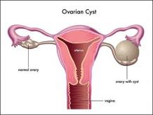 Ovarian Cysts - Causes, Symptoms, Diagnoses &amp; Ayurvedic Treatment