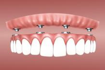 COST OF FULL MOUTH DENTAL IMPLANTS: A COMPREHENSIVE GUIDE